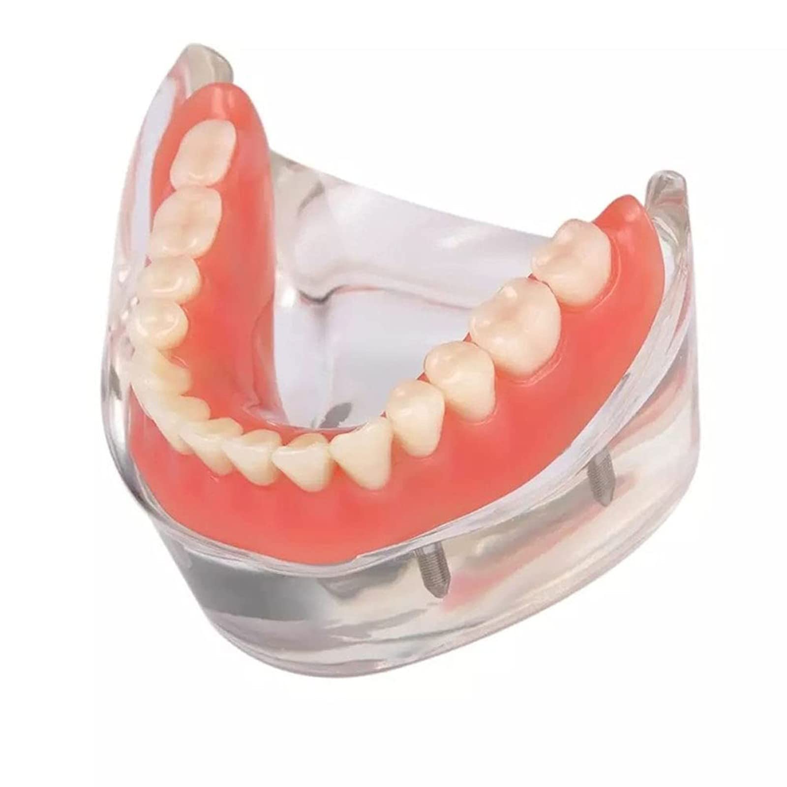 Modelo de sobredentadura Dental, modelo de dientes de enfermedad de implante, demostración de 2 implantes, para enseñar, estudiar, mostrar, comunicación con el paciente
