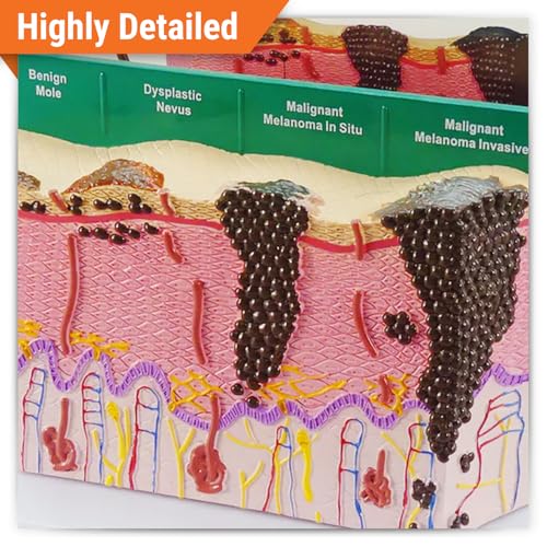 Image of GPI Anatomicals Skin Cancer Model, Skin Replica with Melanoma and Carcinoma | Human Body and Anatomy Replica for Physiology Education, Anatomical Model for Doctor's Office, Medical Learning Resources