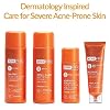 AcneFree Severe Acne Treatment System (2 Pack)