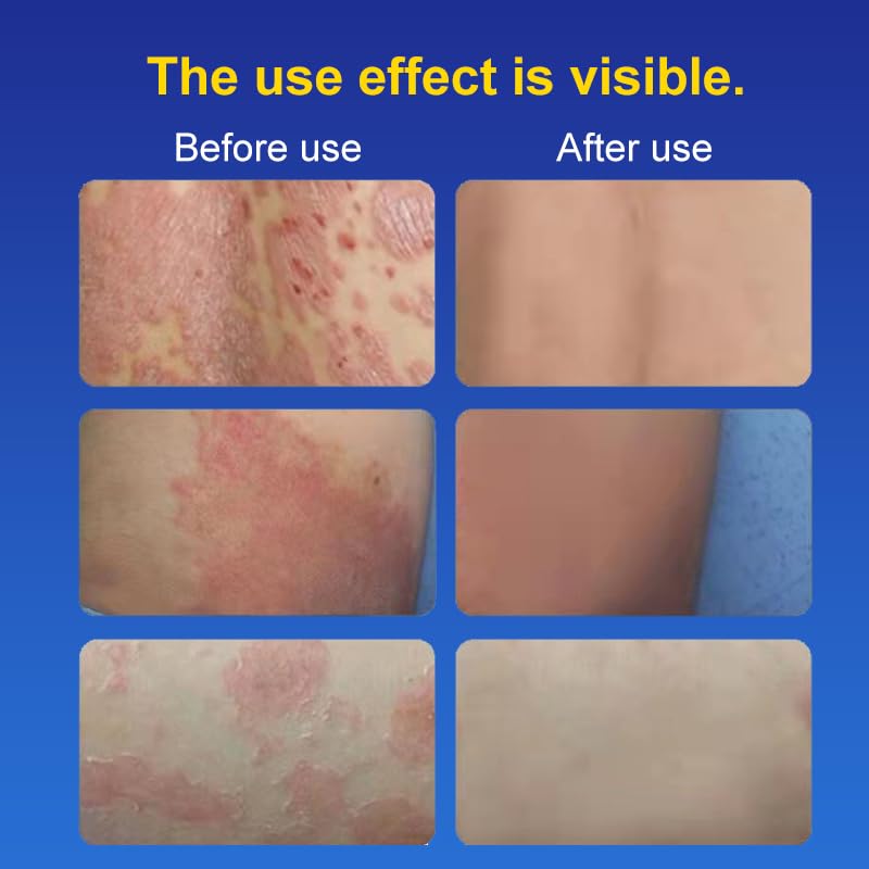 Eczema Care and Anti-itch Cream for Men and Women. Suitable for Dry and Eczema-prone Skin. Suitable for Itchy Skin, Wet Itching, Urticaria, Dermatitis. Unscented and Preservative-free. 20g - Image 5