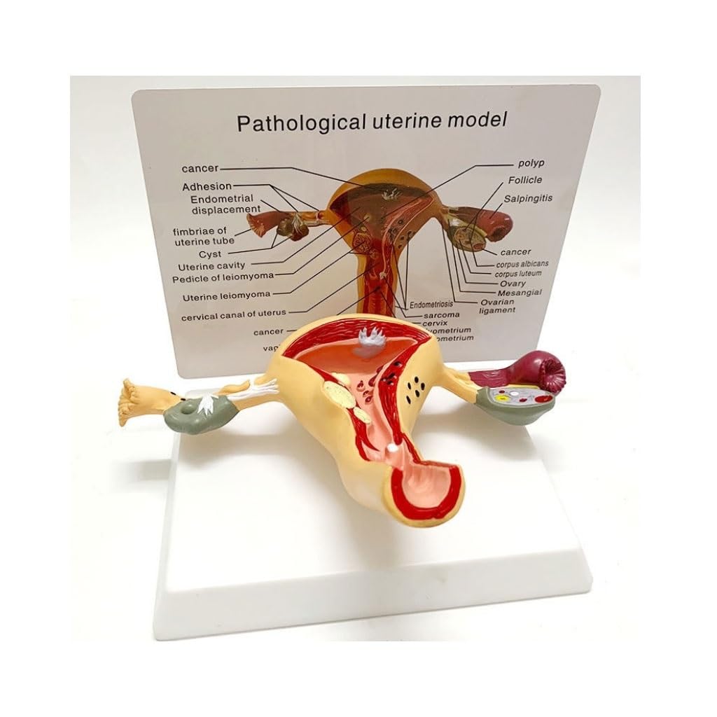 Modèle d'utérus pathologique présentant des maladies courantes. Représentation grandeur nature de l'organe reproducteur féminin montrant l'endométriose