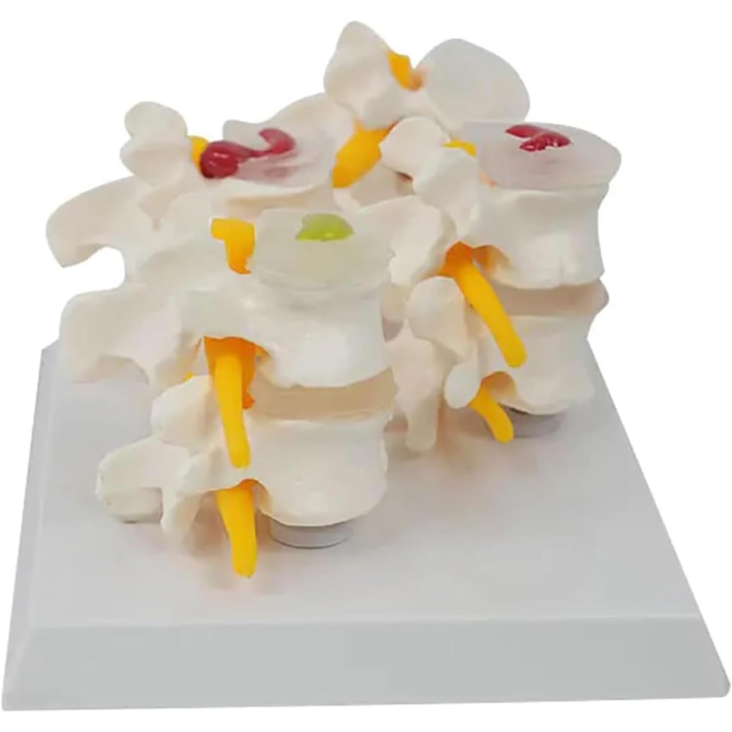 Modelo De Hernia Discal Humana, Modelo De Columna Vertebral Humana, Diseño Detalles Realistas Y Texturas Claras, Mano De Obra Fina Y Soporte Reutilizable, Para La Enseñanza Anatomía Del Esqueleto