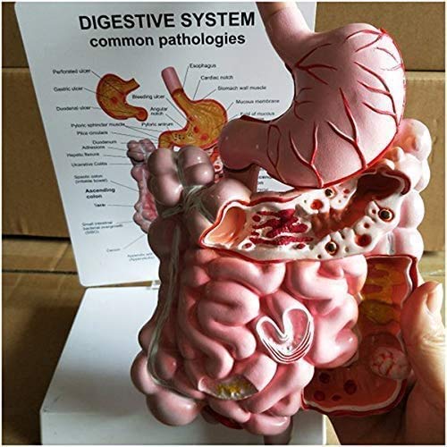 ERNZI Modelli di Materiali Educativi, Modello Educativo Modello di Malattia del Sistema Digerente - Modello di Organo Modello Umano