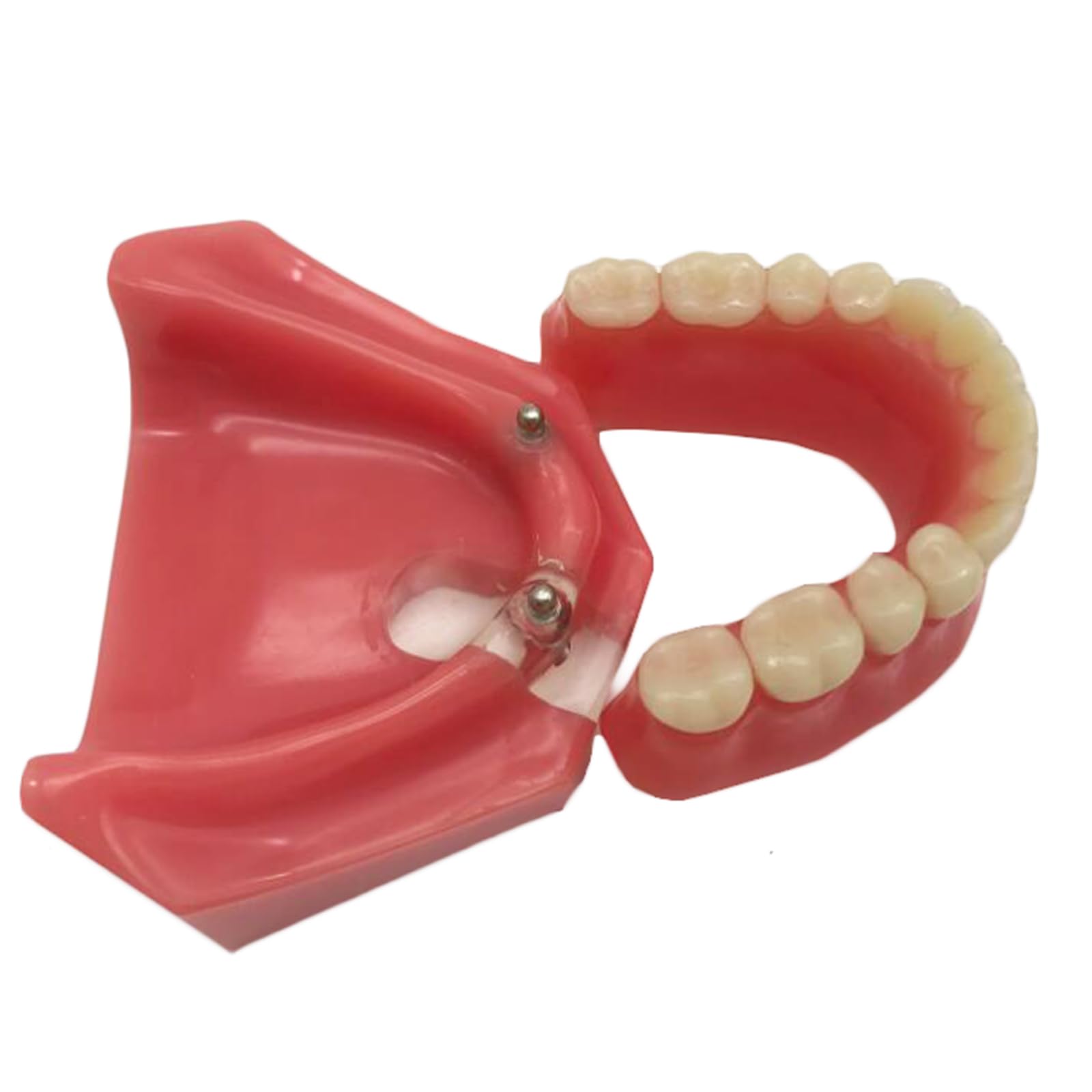 Modello di Denti dentali, Modello di restauro Dentale con 2 impianti, per Laboratorio odontotecnico di Ricerca didattica odontoiatrica