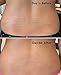 ReTone® Stretch Mark Removal: Comprehensive Stretch Mark Treatment (Stretch Mark Cream + Body Cleanser + Body Scrubber)
