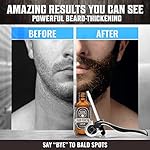 Beard Growth Kit - Oil, Balm, Serum, Derma Roller & Wooden Comb for Beard & Mustache Growth - Image 3