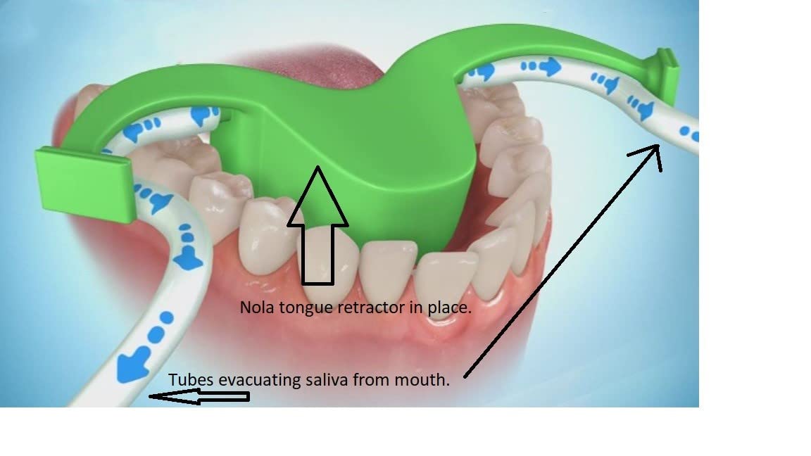 Dental Oral Dry Field System Nola Retractor,Orthodontic Teeth Whitening Cheek Retractor,Autoclavable Dental Mouth Opener,Disposable Dental Lip Cheek Retractor for Mouthguard Small