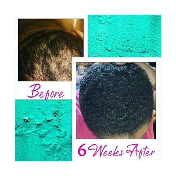 Hair Regrowth Serum ,Hair Growth Oil, Hair Serum, Anti Hair Loss, Thinning, Balding, Repairs Hair Follicles, Hair Salon - Hair Growth TreatmentPromotes Thicker, Stronger Hair, And Promotes Hair Regrowth (30ml)