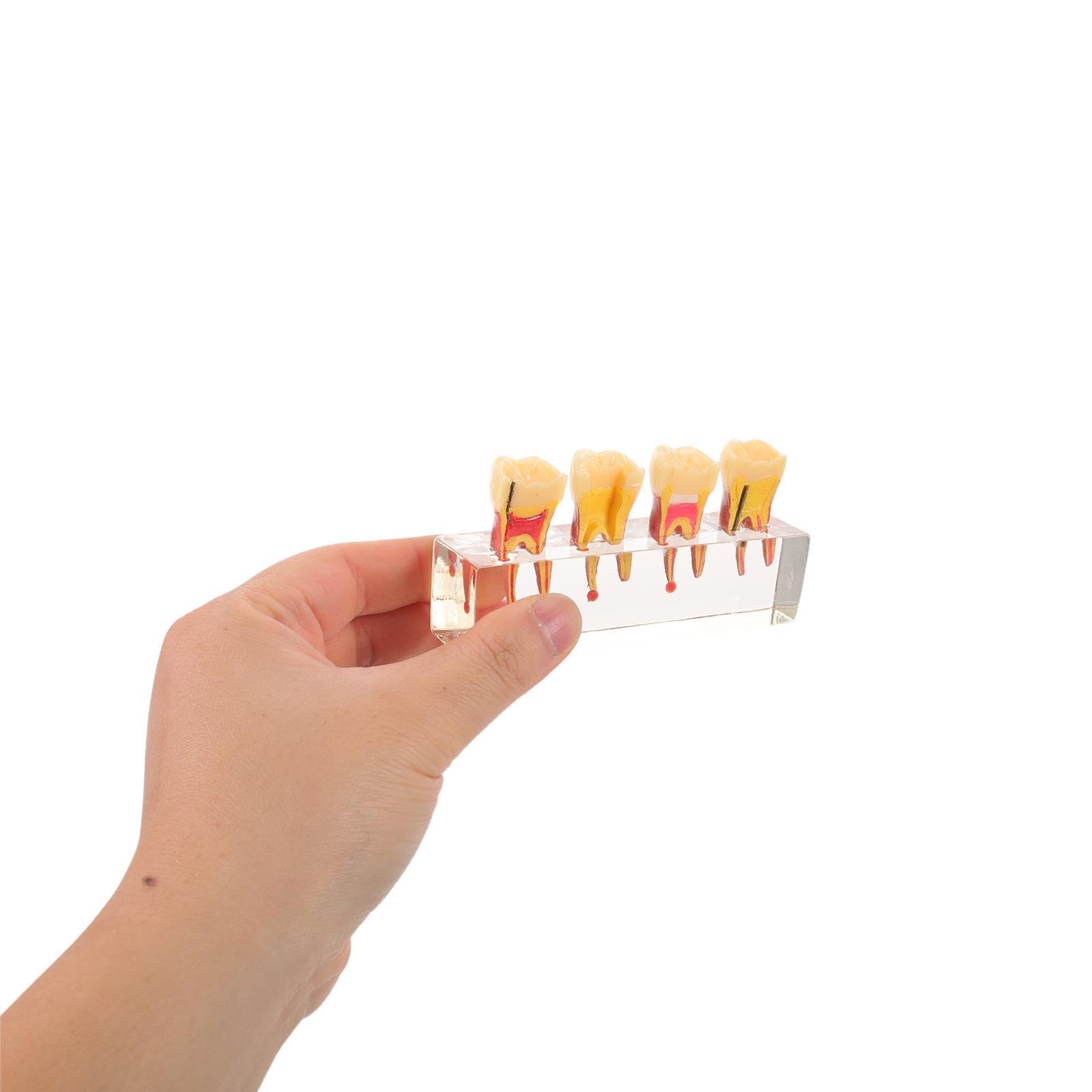 ibasenice Modello di denti pediatrici per la formazione didattica | Rappresentazione realistica dell'anatomia della bocca per studenti di odontoiatria e dentisti | Modello di carie per