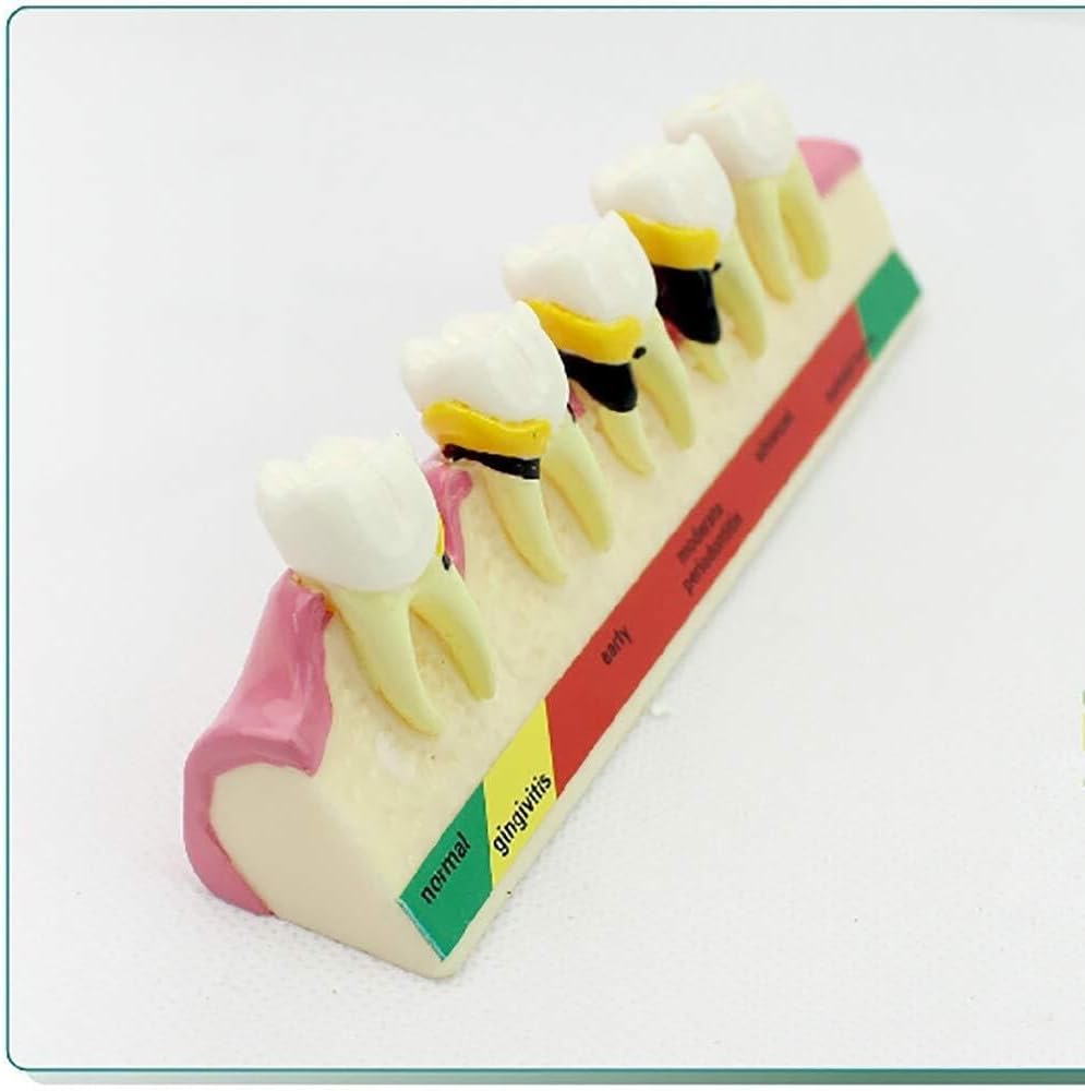 Dental Model, Oral Tooth Disease Classification Model, Gingivitis Degree Chronic Periodontitis Model, Research-Oriented Adult Sta