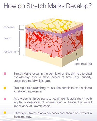 Stretch Mark & Scar Removal Cream – #1 Intensive Stretch Mark & Scar Treatment - Get Rid of Stretch Marks From Pregnancy - Works on New and Old Scars and Stretch Marks.! - By Sieva Skincare