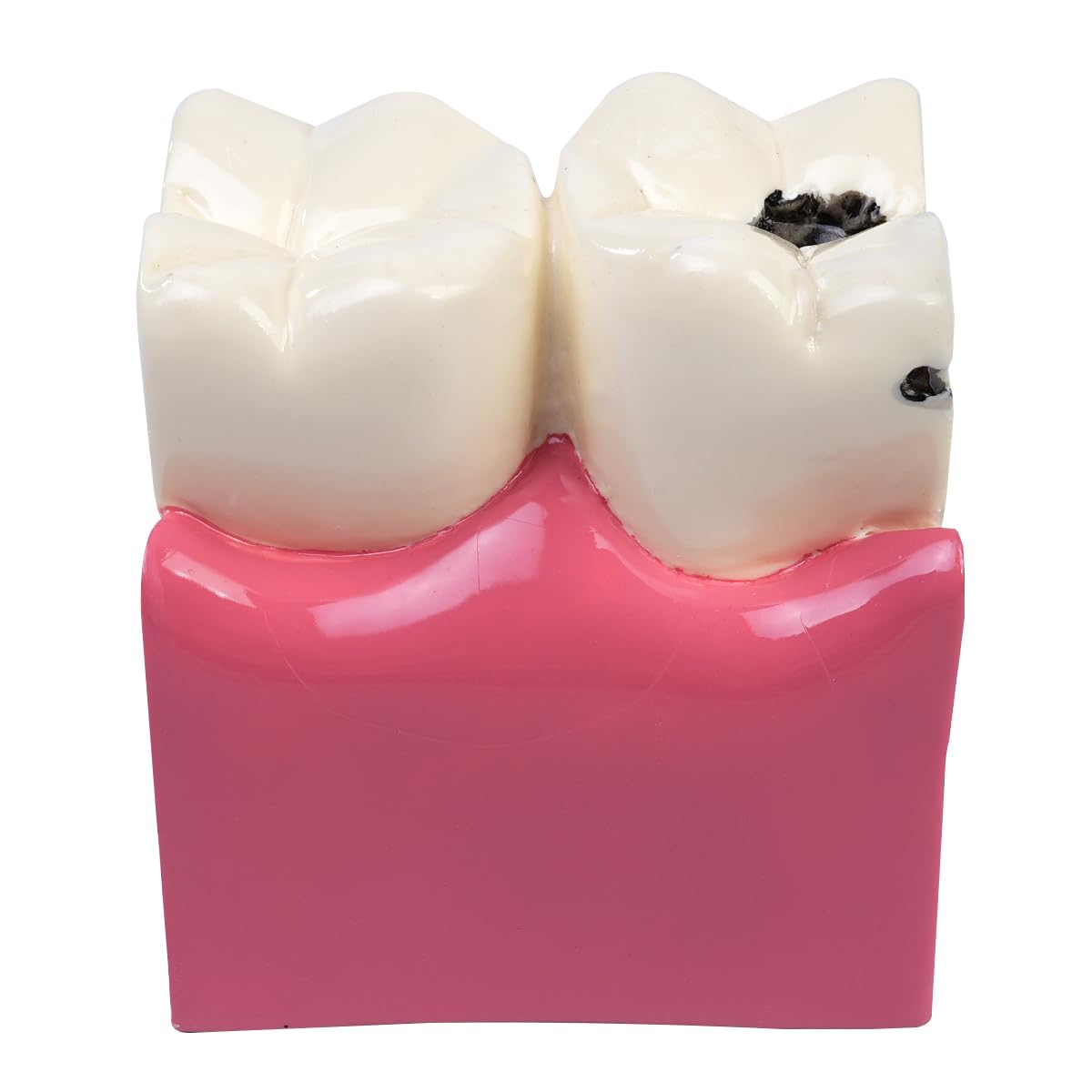 Sarini Modèle Dentaire, modèle d'étude de comparaison des Caries, modèle d'enseignement de l'anatomie Dentaire pour dentistes, adapté aux dentistes, aux Patients, aux Enseignants et aux étudiants