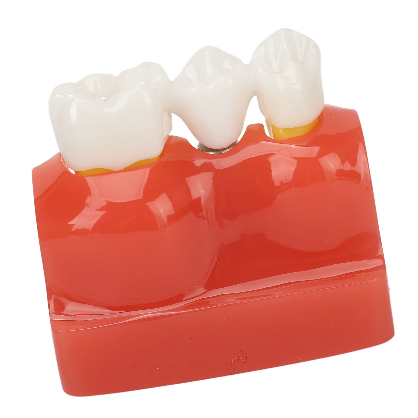 Modelo de implante Dental con Corona y Puente extraíbles para demostración y formación