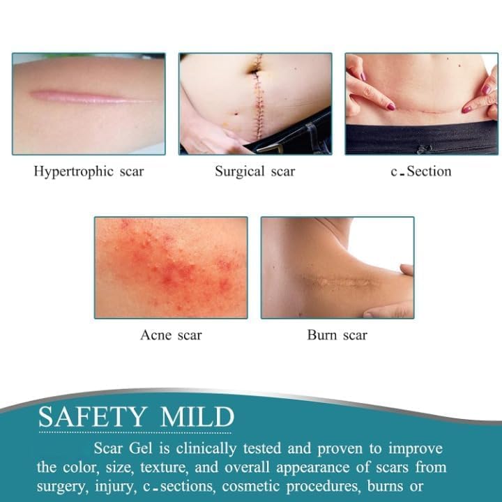 Image of Silicone Scar Removal Tape (1.5M Roll) Medical Grade Reusable Scar Reduction Sheets For Surgical, Handmade, BPA Free,C-Section, Acne, Burn & Keloid Scars Soft & Breathable Skin Tape