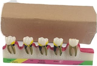 ZMX Teeth Teaching Model Caries Classification Model - Educational Model Peripheral Tooth Pathology Model - Periodontitis Comparison Model - for Dental Medicine Teaching Aids