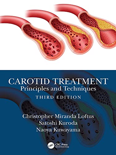 Carotid Treatment: Principles and Techniques (English Edition)