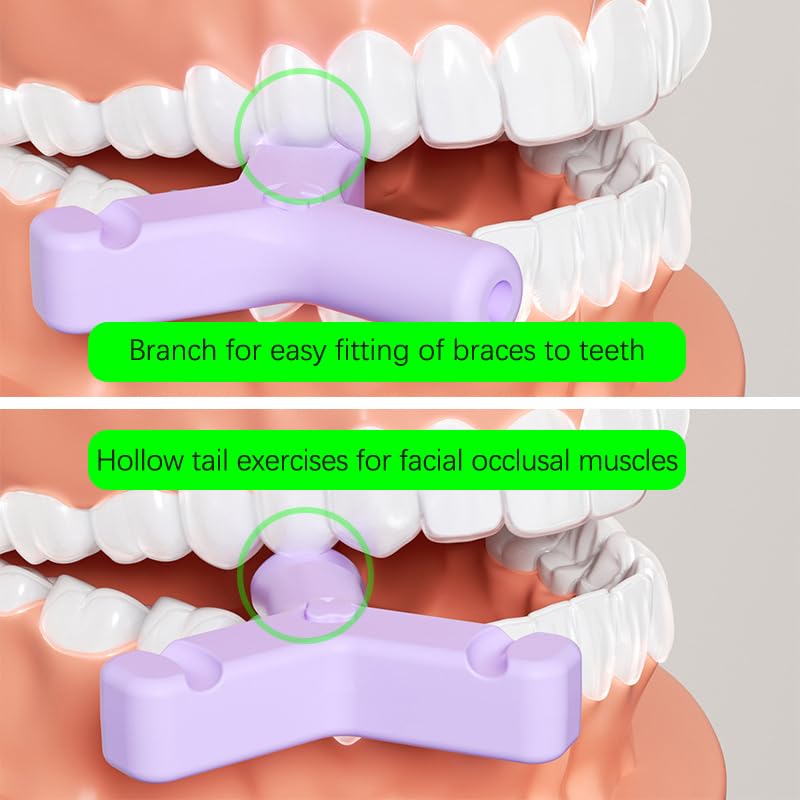 1PC Aligner Chewies pour Invisalign, en Forme de Y Chewies pour Invisalign Plateaux Seater Invisible Accolades orthodontique Munchies Dentaire Chewies,(Couleur aléatoire)
