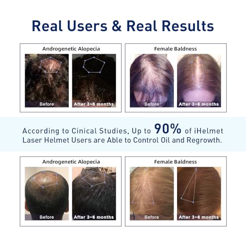 iHelmet Sistema de crescimento capilar a laser (aprovado pela FDA), capacete de crescimento capilar