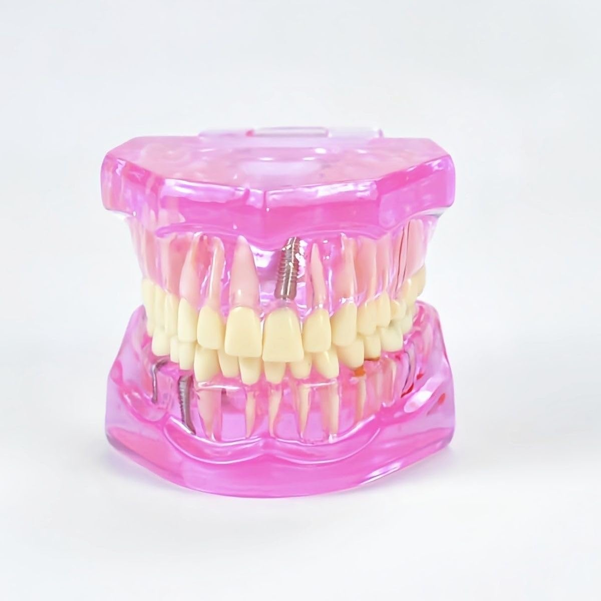 Xiaoxu Modello di Denti patologici, Modello di Denti implantari Trasparenti con Denti Rimovibili per Studio e didattica odontoiatrica.