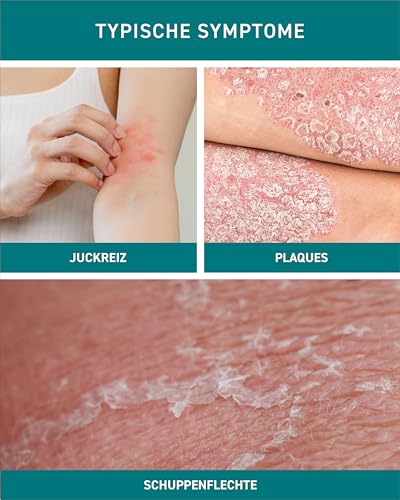 N1 Psoriasis Intensivcreme 50 ml - Ekzem & Neurodermitis Creme - beruhigt, pflegt, lindert und glättet rote, schuppige, entzündete & trockene Haut