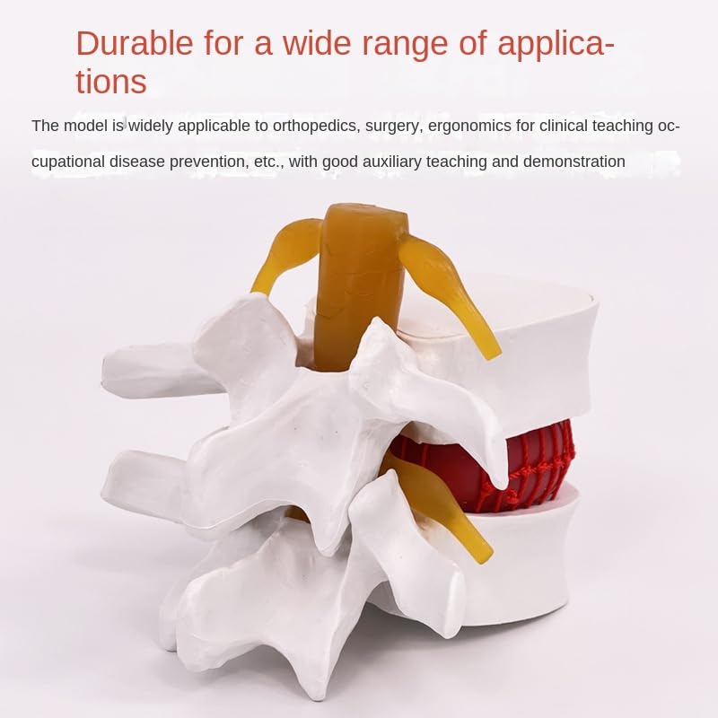 MODELLO DI ERNIA Del Disco Lombare Umano Modello Di Colonna Lombare Per La EUR 33,59 - IT