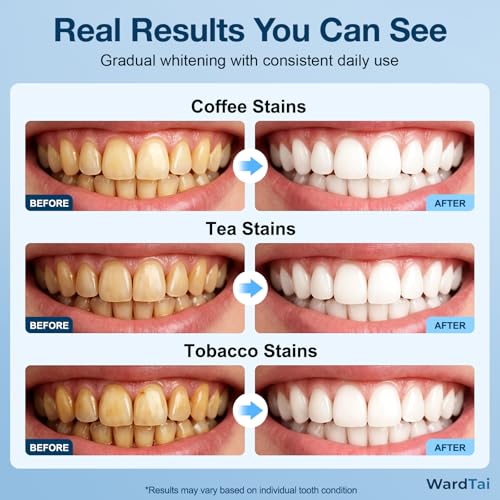 Image of Teeth Whitening Kit with 32 LED Dual Light, 3 Gentle Whitening Gel Pens, Rechargeable Teeth Whitening Light Kit for Sensitive Teeth, Coffee Stain Whitening, Shade Guide Included