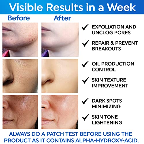 20% Glycolic Acid+ 2% Salicylic Acid Acne Pads For Face Exfoliating & Resurfacing, Aha Bha Facial Peel Pads For Skin Toning Blemish Control Revealing Bright, Youthful, Radiant Skin (50 Count) #TOP3