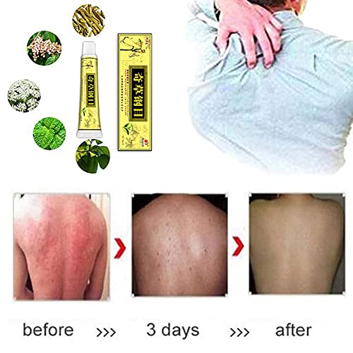 Natural Chinese Herbal Cream, Eczema Cream, Anti-Itch Cream, Dedicated for Dermatitis and Eczema Pruritus Psoriasis… - Afbeelding 7