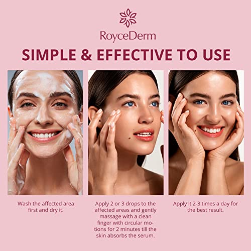 Roycederm Stye Eye Treatment, Chalazion Remover, Eye Stye Remover, Stye Eye Relief Serum For Styes Chalazion And Blepharitis Treatment, Fast Relief #TOP4