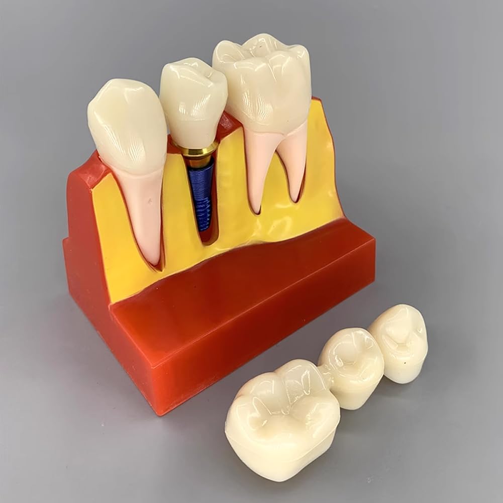 Modèle D'implant Dentaire - Modèle De Dent De Démonstration Pour Couronne Bridge Amovibles (4 Fois) - Modèle De Dent Pour L'analyse D'implants Dentaires À Des Fins D'apprentissage De Formation