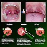 Airgoesin™ 6.75 inch Tonsil Stone Remover LED Tool Kit - 2 Sets, Oral Irrigation Syringe & Stainless Steel Pick, Tonsil Stone Removal Kit for Breath Freshening - Image 5