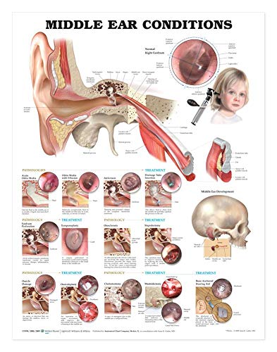 Middle Ear Conditions Anatomical Chart