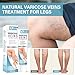 Hackerdom Varicose Veins Treatment for Legs, Varicose Veins Cream, Effectively Improves Blood Circulation, Relieves Leg Fatigue, Reduces Spider Veins