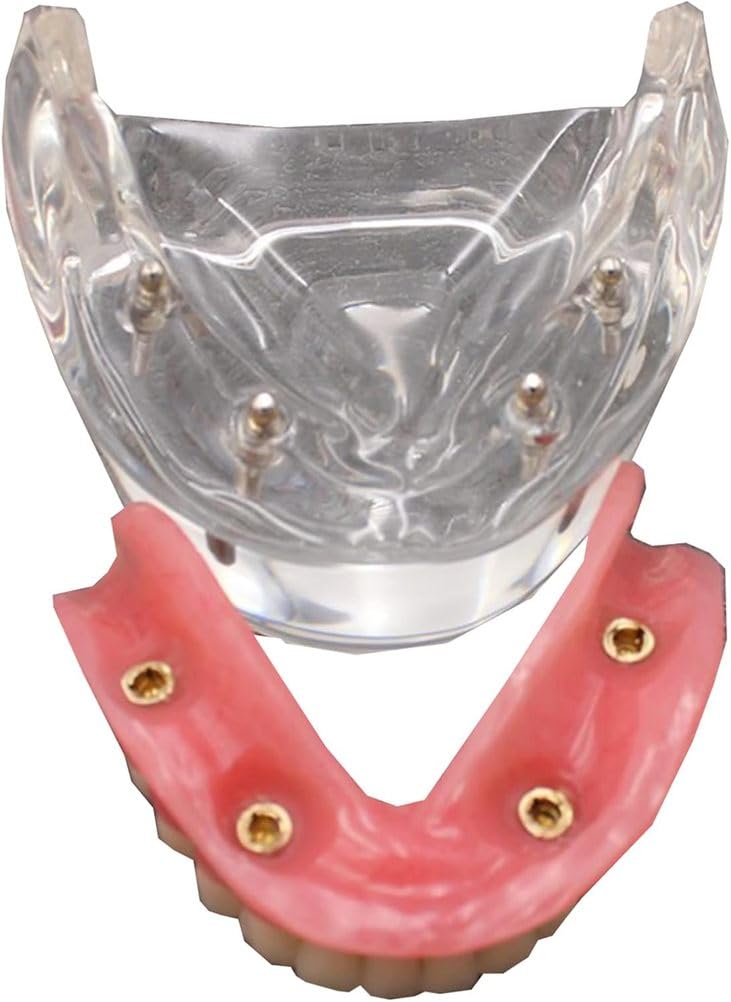 Model zębów implantów dentystycznych Wyczyść opóźnienie 4 Implanty górnej górnej bazy szczękowej do studiowania nauczania