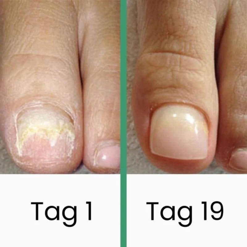 Podomax PODOclip® | LLLT-Nagelpilztherapie(1 Stück)