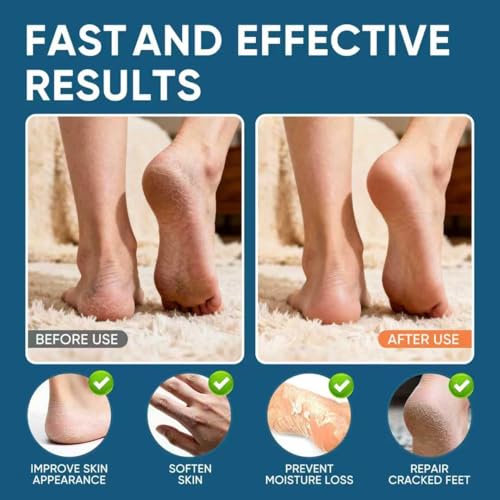 Urea Cream 42 Percent For Fee,Feet Cream for Cracked Heel Feet Knees Hands Elbows for Dry Cracked,Foot Moisturizer for Skin Care - Image 4