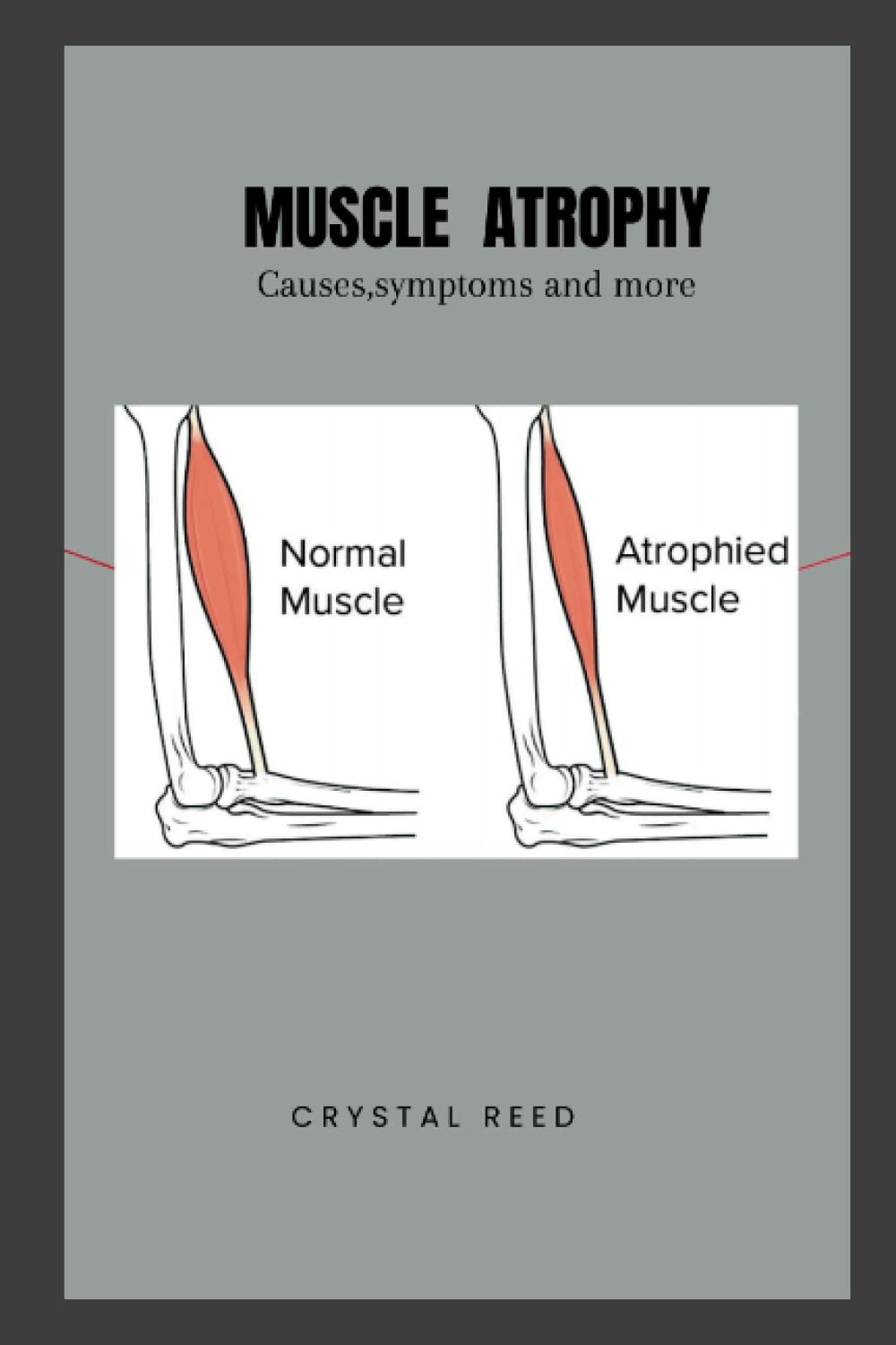 MUSCLE ATROPHY: Causes,symptoms and more