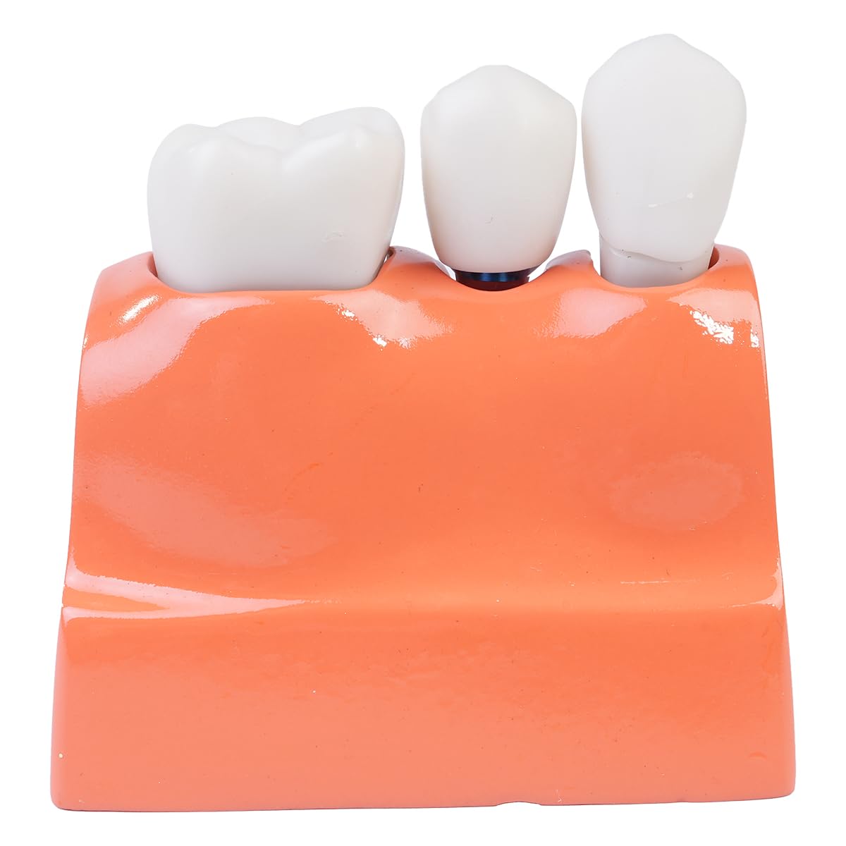 Sarini Modelo de Diente Oral, Modelo de implante Dental con Corona y Puente extraíbles para demostración y formación