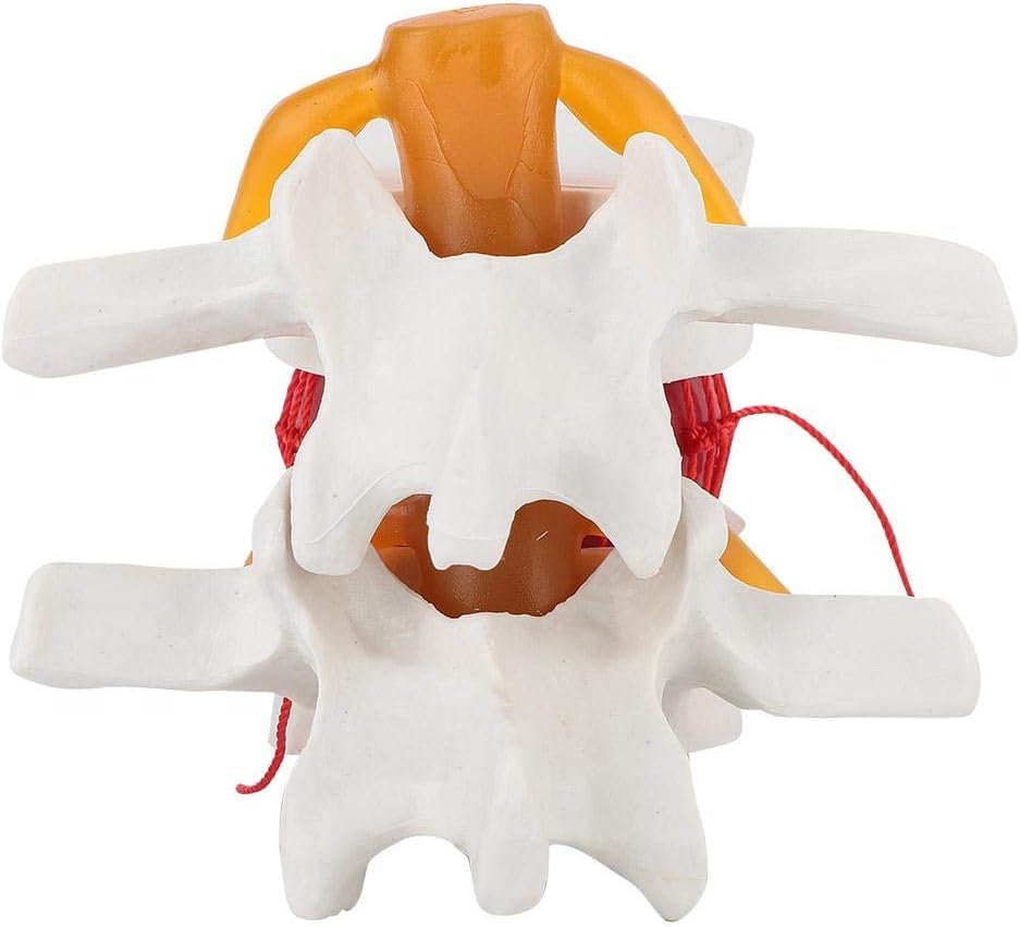 Image of Herniated Disc Spine Model, 1.5X Life Size Lumbar Spine Anatomy Model for Teaching, Chiropractic Demonstration, Medical Learning and Patient Education (1pc Spine and Disc Model)