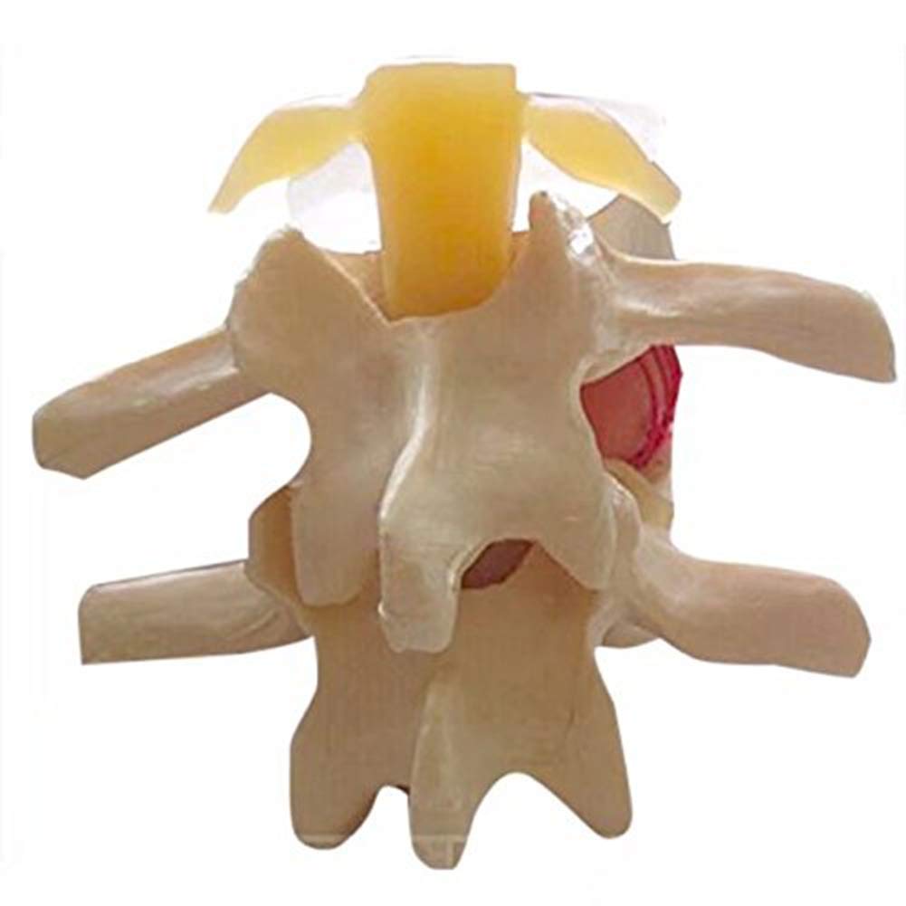 Anatomia Umana, 1:1.5 Modello Dimostrativo Di Ernia Del Disco Lombare Umano Modello Di Colonna Vertebrale Lombare Per Dimostrazione Medica