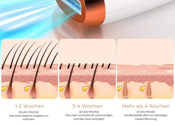 Haarentfernungsgerät für Damen und Herren – Dauerhafte Haarentfernung mit 990.000 Lichtimpulsen, Schmerzfrei, Saphir Technologie, Für Zuhause & Ganzkörper (Rosa)