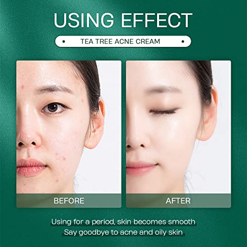Akary Tea Tree Oil Face Cream Acne Cream - For Oily, Acne Prone Skin, Extra Soothing & Nourishing Non-Greasy Botanical Facial Moisturizer, Acne Removal, Gently Repair For Acne Skin, Cystic Acne, Pimple & Redness #TOP5