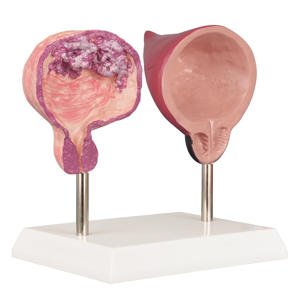 YRQMGSF Healthy Bladder and Pathological Bladder Anatomical Model Comparative Demonstration Model Of Removable Pipe Bladder