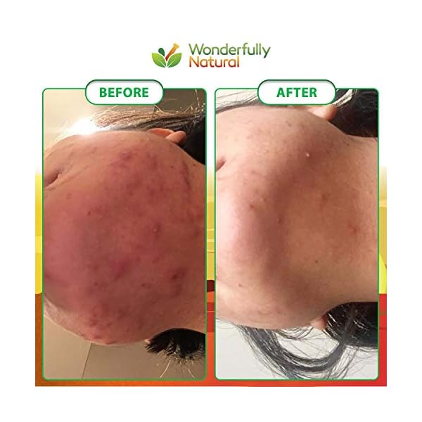 Organic African Black Soap - For Acne & Dark Spots | Natural Vegan and Cruelty Free â Satisfaction Guarantee 1lb bar | 90 day Supply