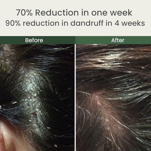 Image of Wildly Pure Natural Anti Dandruff shampoo|Nasturtium, Piroctone olamine, Niacinamide & Biotin| 72% less in Dandruff in 3 wash| Regulates Sebum, Reduce Itchiness, redness| Chemical free|150mL (Calm)