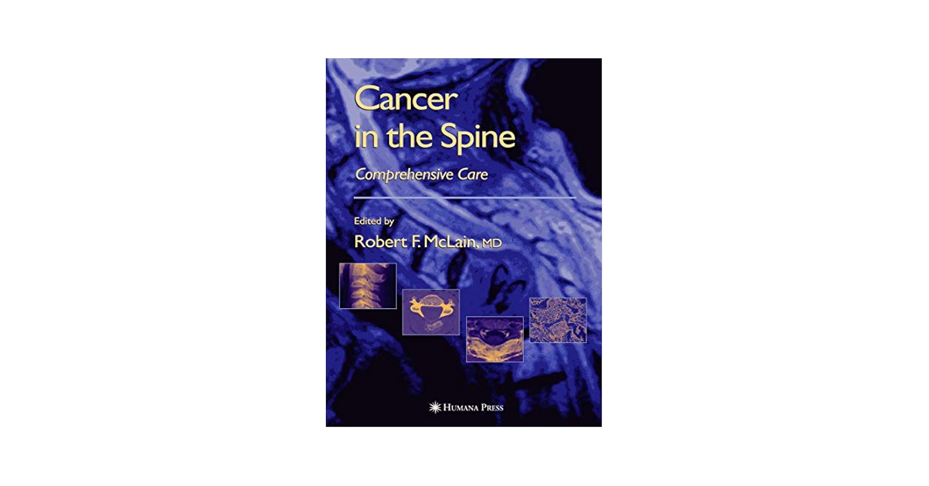 Cancer in the Spine: Comprehensive Care (Current Clinical Oncology) [ペーパーバック] various， .、 McLain， Robert F.、 Markman， Maurie、 Bukowski， Ronald M.、 Macklis， Roger; Benzel， Edward C. Cancer in the Spine: Comprehensive Care (Current Clinical