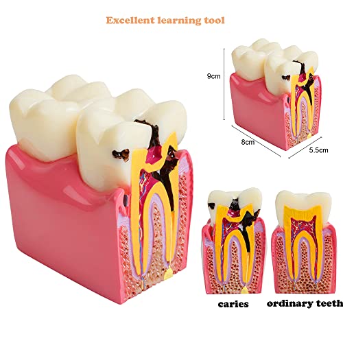 Pevor New Dental Teeth Model Dental Caries Tooth Model Patient Education Teeth Model 6 Times Caries #TOP1