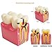 Pevor New Dental Teeth Model Dental Caries Tooth Model Patient Education Teeth Model 6 Times Caries