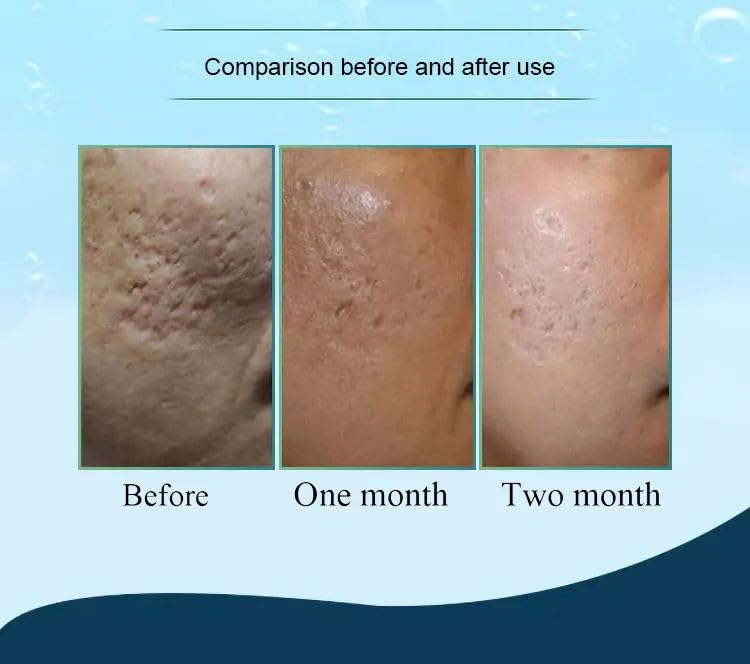 Miniatura 6 de Hydra Needle 20 Herramientas aplicadoras de suero de titanio reutilizables