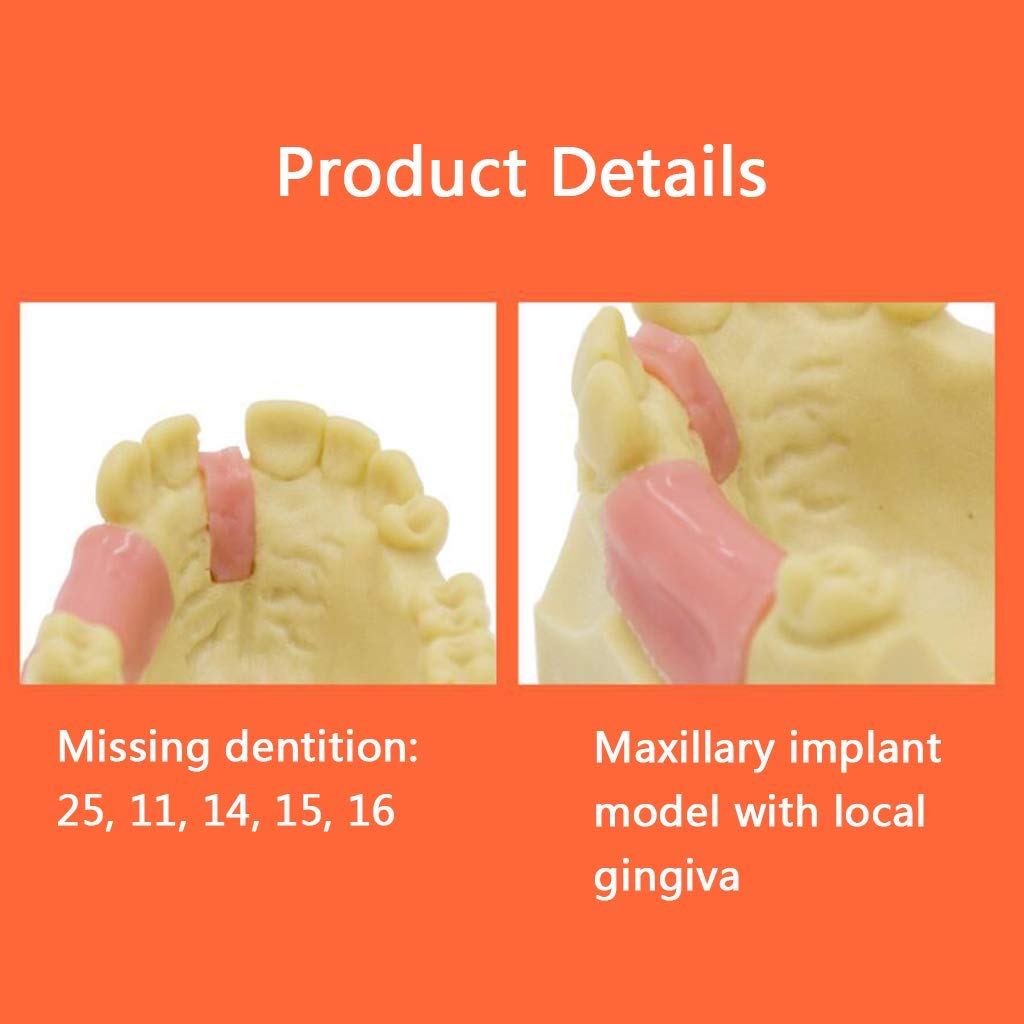Zęby Model Denture Repair Sadzenie Szkolenia Żywicy Materiał Medyczny Pomoc Szkoleniowa Medyczna
